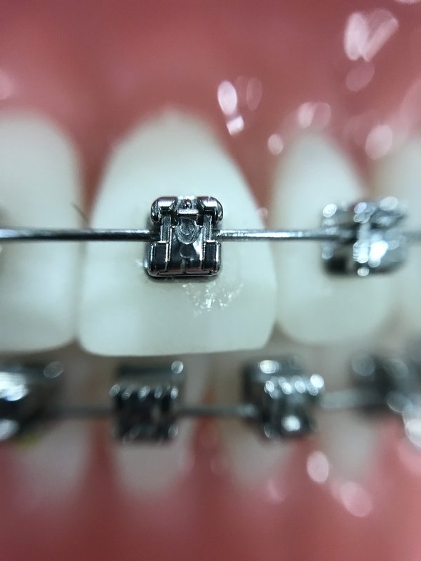 Comment trouver une gouttière orthodontie pas chère sans compromettre la qualité ?