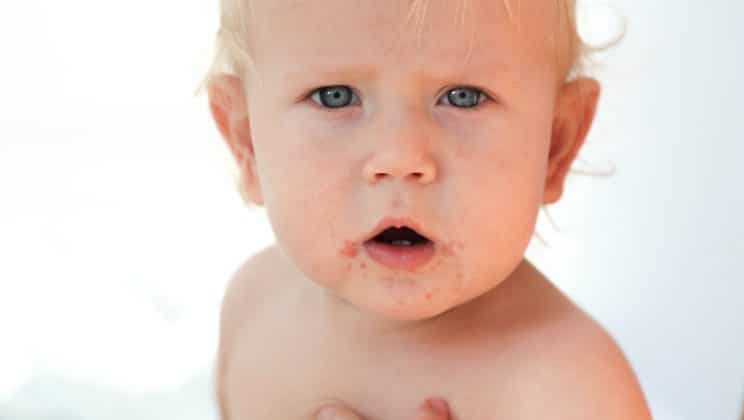 Bouton rouge bébé : que faire en cas d’éruption cutané du bébé ?
